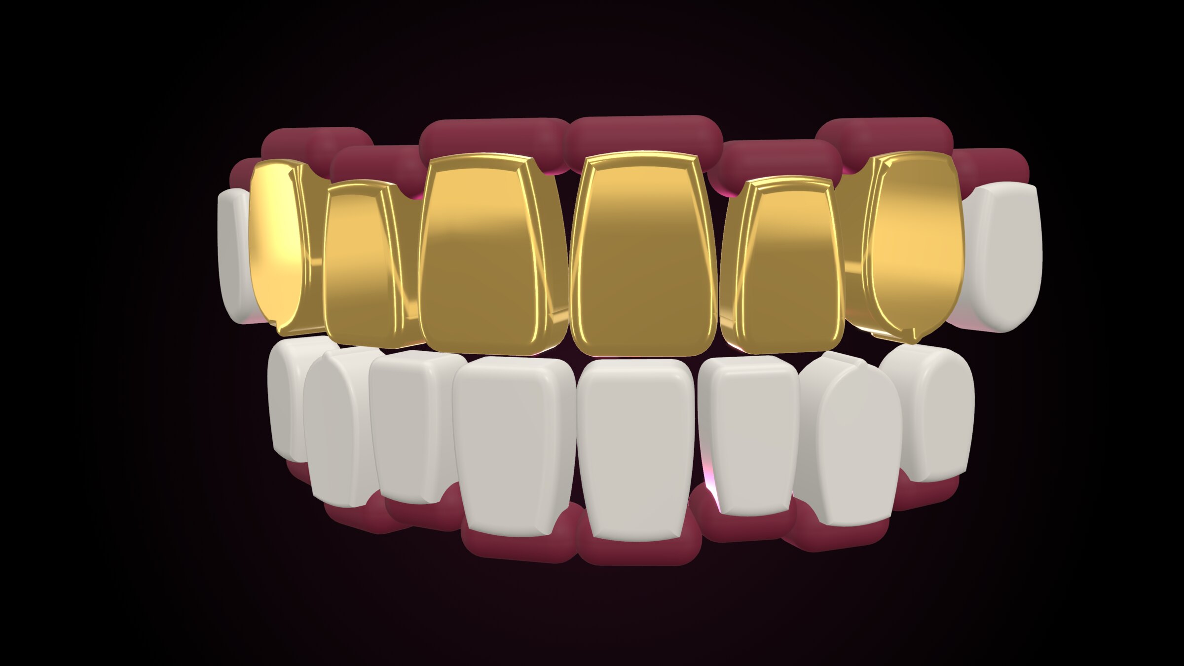 3D render of an 18ct gold top-six grill worn on a smile